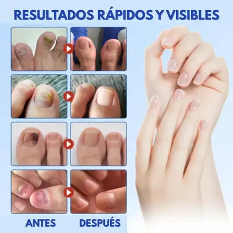 2x1 NailRestore - Tus uñas de vuelta a la normalidad